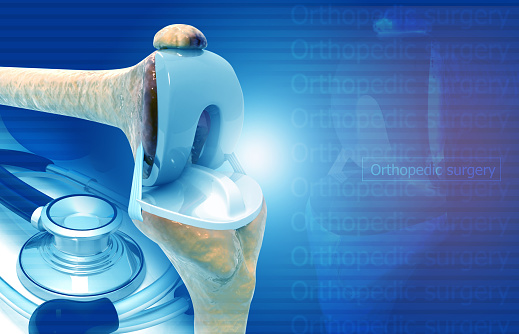 Joint Replacement